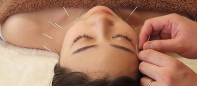 美容鍼